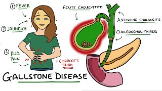 Gallstone Disease  Acute Cholecystitis vs Cholelithiasis vs Choledocholithiasis vs Cholangitis [upl. by Yrrum]