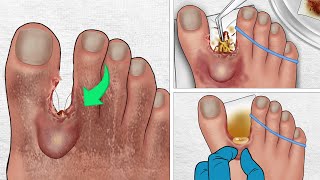 ASMR Cockroaches crawl into toe cracks  Treatment amp Removal Animation [upl. by Ahsienom413]