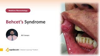 Behcet´s Syndrome  Rheumatology Medicine Video Lectures  Medical Student  VLearning [upl. by Gerbold]