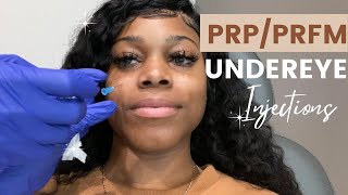 PRPPRFM Under Eye Injections  DARK CIRCLES AND VOLUME LOSS UNDER YOUR EYES [upl. by Notlehs889]