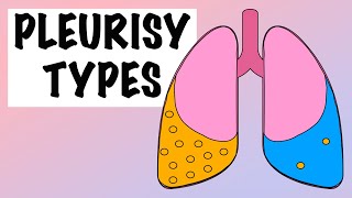 DIFFERENCES BETWEEN EXUDATIVE AND TRANSUDATIVE PLEURAL EFFUSION [upl. by Vevina]