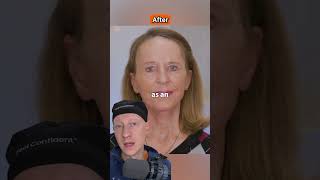 AMAZING Facelift amp Laser Resurfacing Transformation  Plastic Surgeon Reacts [upl. by Sansen]