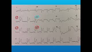 ECG interpretation STEMI vs NSTEMI [upl. by Tare]