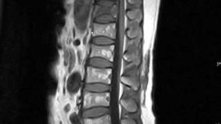 MRI interpretation  intraosseous hemangioma spine [upl. by Navanod835]