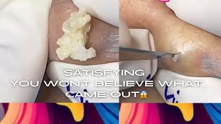 OMG 🤯YOU WONT BELIEVE WHAT CAME OUT 😲 SO SATISFYING [upl. by Nessej]