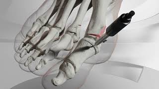 Hallux valgus miniinvasif percutané  Chirurgie correction  Dr Simon Tournemine [upl. by Tasiana732]