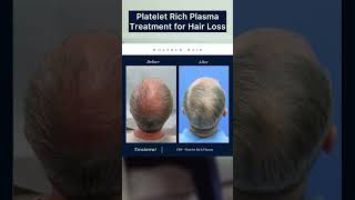 Hair Restoration before amp after with PRP  Platelet Rich Plasma Treatment [upl. by Aruam]