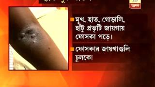 New disease in Kolkata hand foot mouth disease [upl. by Signe776]