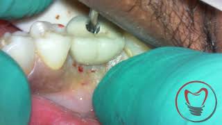 Removing a Broken Implant Screw [upl. by Ahsieken]