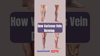 How Varicose Vein Develop By OperationTheatreSKR Health Viral Shorts [upl. by Lairbag968]