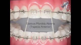 How to Wear Orthodontic Elastic Bandsكيفية وضع مطاط التقويم [upl. by Jessen763]