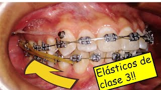 Elásticos intermaxilares de clase 3 en ortodoncia 💪como se usan [upl. by Yrohcaz31]