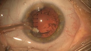 Cataract Surgery ComplicationsPosterior Capsular Rupture [upl. by Tiersten]