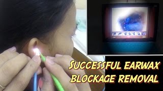 Successful Earwax Cerumen Blockage Removal [upl. by Hey]