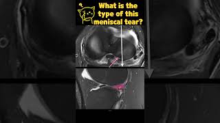 Fig 1B04 LongitudinalVertical Meniscal Tears with ACL tear [upl. by Rosenkranz]