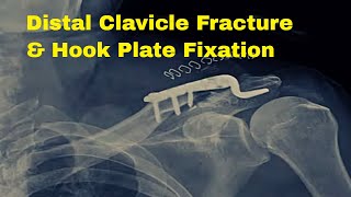 Mastering Hook Plate Fixation Tackling Distal Clavicle Comminuted Fractures [upl. by Ajuna]