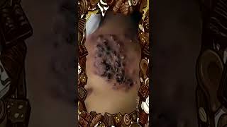 Blackheads Removal  Acne Treatment and Very Satisfying Satisfying Pimple pop blackheads [upl. by Dalis]