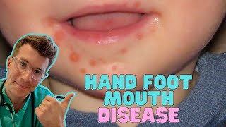 How to recognise amp treat Hand Foot and Mouth Disease Coxsackievirus in kids  Doctor ODonovan [upl. by Mctyre]