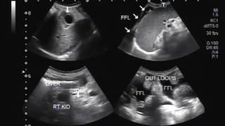 Ultrasound Video showing findings of a typical patient suffering from Hepatic Parenchymal disease [upl. by Samuele]