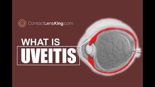 Uveitis Eye Symptoms and Causes [upl. by Anauqahc]