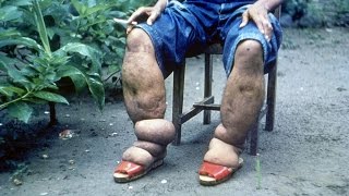 Lymphatic Filariasis Elephantiasis [upl. by Ailido]