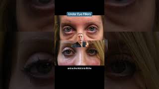 Under Eye Fillers [upl. by Strohben]