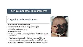 Congenital Melanocytic Nevus  Spot Diagnosis 27  Pediatrics [upl. by Ayotahc426]