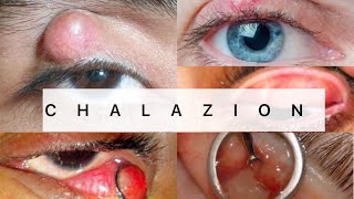 Chalazion  Ophthalmology  EASY MBBS [upl. by Hare83]