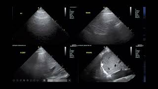 Normotensive Cardiogenic Shock [upl. by Arolf]