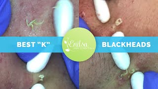 quotKsquot Best Blackhead Extraction Compilation Part 1 [upl. by Elocim232]