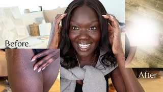 Vlog Stretch Mark Removal on Dark Skin [upl. by Dlonra]