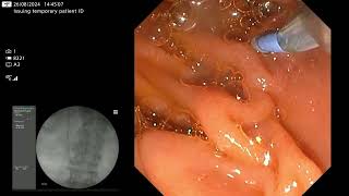 Trapezoid lithotripsy  how I do it [upl. by Ailil]