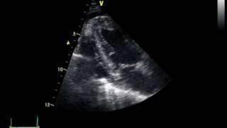 CHRONIC PERICARDITIS with thickening of the pericardium [upl. by Meeks911]