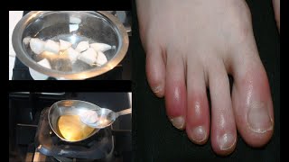 ठंड में हाथ पैरों की उंगलियों मे सूजन व खुजली के घरेलू इलाज़ Home Remedies for Chilblains Perniosis [upl. by Aikin]