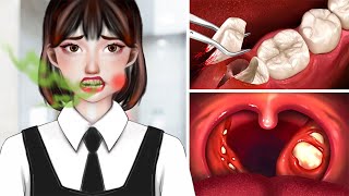 ASMR Salivary Gland Stones Removal Animation ASMR Dental Cleaning Procedures [upl. by Ennej]