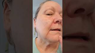 Healing on Day 20 after a 21 day 5 Fluorouracil treatment for Basal Cell Carcinoma 2132023 [upl. by Rebel]