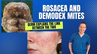 Dermatologist explains Rosacea and the link with Demodex Mites What can be done Rosacea demodex [upl. by Ahkos]