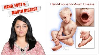 HAND FOOT MOUTH DISEASE  बच्चों में हाथ पैर और मुँह का रोग  HFM [upl. by Luce]