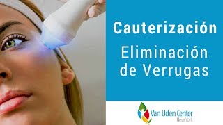 Cauterización  Eliminación de Verrugas  Dr Alfonso Van Uden [upl. by Htepsle]