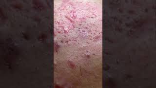 ACNE SEVERE EXTRACTION PAR 1 CHIRURGIEN acne acnetreatment santé boutons femmeacnepositive [upl. by Ennovyahs]