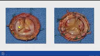 Prosthetic Valve Choice in TAVR Era [upl. by Ecirtac]