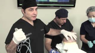 Robotic Hair Transplant [upl. by Mooney]