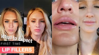 My first time getting LIP FILLERS before AND after  1 syringe Juvederm Ultra [upl. by Kress140]