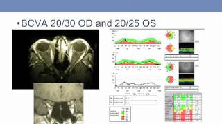 Discussion  Craniopharyngioma  UCLA Pituitary Tumor Program [upl. by Ahders]