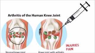 PRP Injection vs Adipose Stem Cell Therapy for Knee Arthritis [upl. by Annet345]