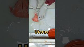 uterus with bilateral adnexa specimen [upl. by Nylissej116]