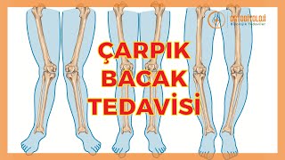 ÇARPIK BACAK SORUNLARI VE ÇARPIK BACAK TEDAVİLERİ [upl. by Ellehsor186]