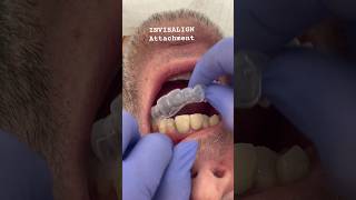 INVISALIGN Attachments invisalign oralhealth viralshortstrending youtubeshorts dentist pov [upl. by Warton]