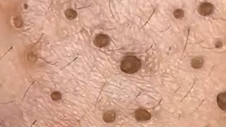 Blackheads amp Whiteheads Satisfying Removal 0116 [upl. by Yeneffit]