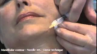 Viscoderm 16 30 Gneedle Dr Salti [upl. by Eemia]